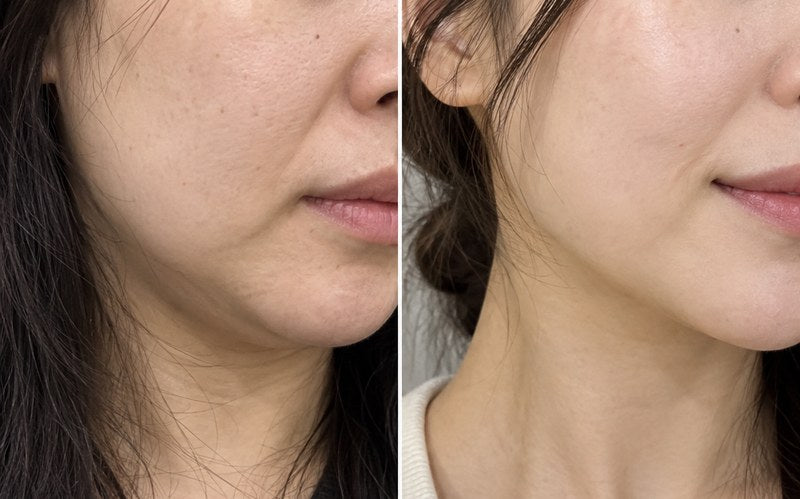HyperLift before and after