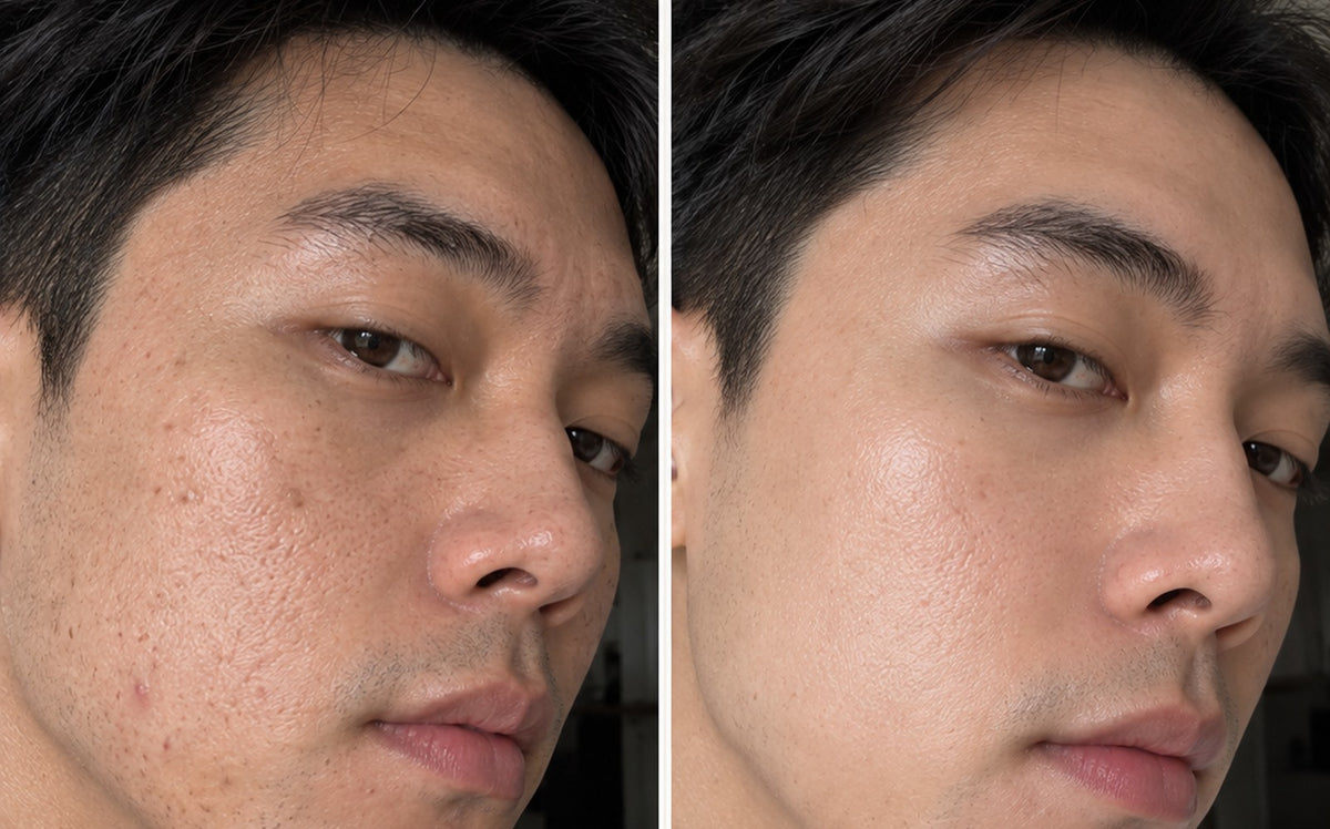 SRG before and after